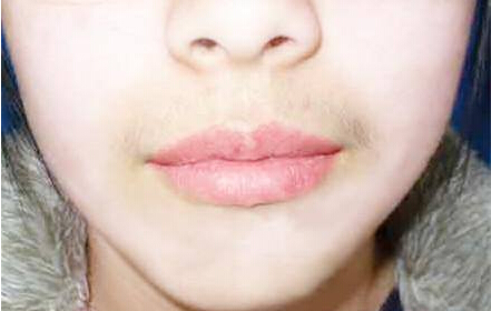 微量元素检测仪女神节福利女性长胡子内分泌紊乱 微量元素检测仪女神节福利女性长胡子内分泌紊乱